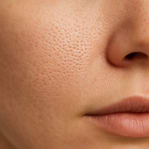 درمان منافذ باز پوست